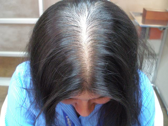 alopecia androgenica femenina
