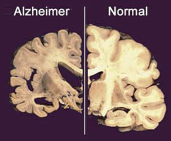 Alzheimer