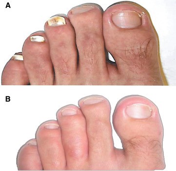 Uñas de los pies. Antes y 48 semanas después de usar VapoRub como tratamiento tópico.