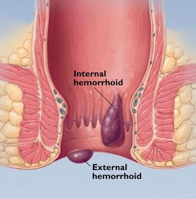 hemorroides externos