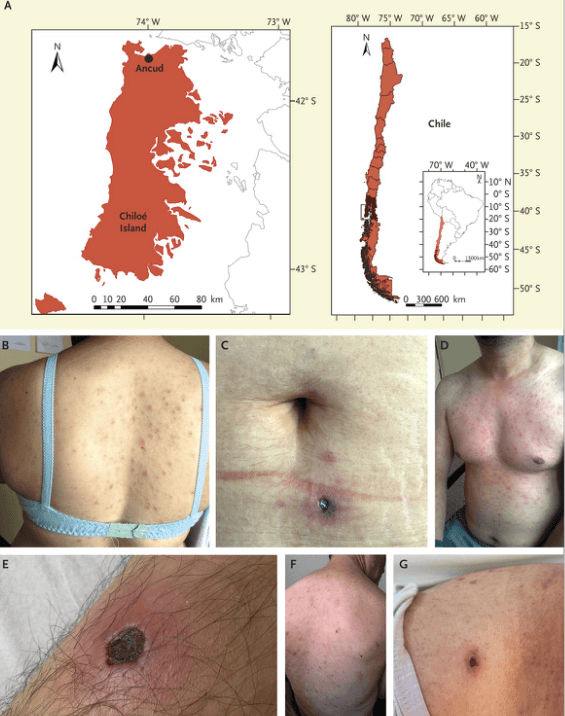 fiebre tsutsugamushi en chile